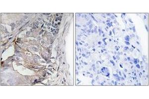 Immunohistochemistry analysis of paraffin-embedded human colon carcinoma, using PDGFR beta (Phospho-Tyr740) Antibody. (PDGFRB Antikörper  (pTyr740))