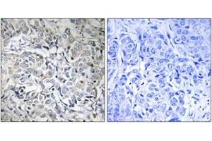 Immunohistochemistry analysis of paraffin-embedded human breast carcinoma, using NF-kappaB p65 (Phospho-Thr505) Antibody.
