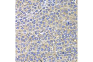 Immunohistochemistry of paraffin-embedded mouse cancer using STAT4 antibody. (STAT4 Antikörper)