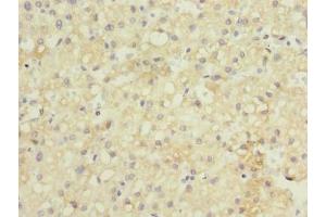 Immunohistochemistry of paraffin-embedded human liver cancer using ABIN7154545 at dilution of 1:100 (GDF2 Antikörper  (AA 300-429))