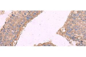 Immunohistochemistry of paraffin-embedded Human liver cancer tissue using KCNN3 Polyclonal Antibody at dilution of 1:40(x200)