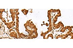 Immunohistochemistry of paraffin-embedded Human thyroid cancer tissue using FAM50A Polyclonal Antibody at dilution of 1:25(x200)