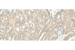 Immunohistochemistry of paraffin-embedded Human liver cancer tissue using ROM1 Polyclonal Antibody at dilution of 1:25(x200)