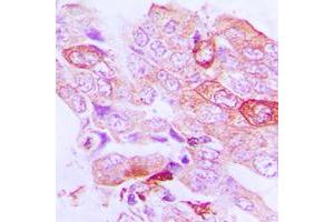 Immunohistochemical analysis of STK33 staining in human lung cancer formalin fixed paraffin embedded tissue section. (STK33 Antikörper  (N-Term))