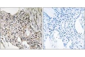 Immunohistochemistry analysis of paraffin-embedded human breast carcinoma tissue, using UEVLD Antibody. (UEVLD Antikörper  (AA 141-190))