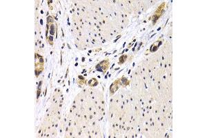 Immunohistochemistry of paraffin-embedded human stomach cancer using ATF2 antibody at dilution of 1:200 (400x lens). (ATF2 Antikörper)