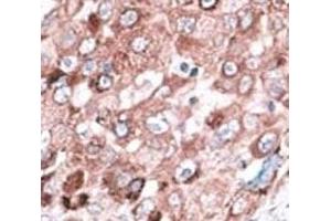 IHC analysis of FFPE hepatocarcinoma cancer tissue stained with the Bak antibody (BAK1 Antikörper  (AA 56-91))