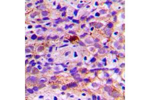 Immunohistochemical analysis of CES2 staining in human breast cancer formalin fixed paraffin embedded tissue section.