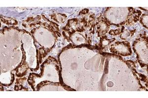 ABIN6267192 at 1/100 staining Human thyroid cancer tissue by IHC-P.