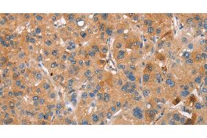 Immunohistochemistry of paraffin-embedded Human liver cancer using PLIN2 Polyclonal Antibody at dilution of 1:30 (ADRP Antikörper)