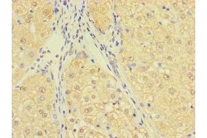 Immunohistochemistry of paraffin-embedded human liver cancer using ABIN7174695 at dilution of 1:100 (C1ORF111 Antikörper  (AA 1-114))