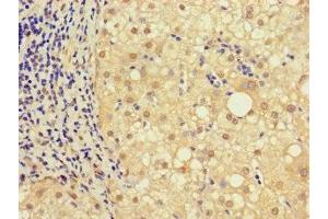 Immunohistochemistry of paraffin-embedded human liver cancer using ABIN7161926 at dilution of 1:100 (NRIP3 Antikörper  (AA 1-241))