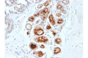 Formalin-fixed, paraffin-embedded human Breast Carcinoma stained with Mammaglobin-Monospecific Mouse Monoclonal Antibody (MGB1/2000). (Mammaglobin A Antikörper)