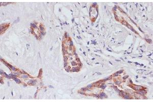 Immunohistochemistry of paraffin-embedded Human liver cancer using RAP1A Polyclonal Antibody at dilution of 1:100 (40x lens).