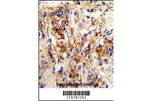 Formalin-fixed and paraffin-embedded human hepatocarcinoma reacted with CYP2J2 Antibody (N-term), which was peroxidase-conjugated to the secondary antibody, followed by DAB staining. (CYP2J2 Antikörper  (N-Term))