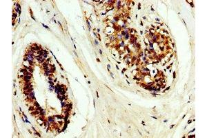 IHC image of ABIN7159489 diluted at 1:200 and staining in paraffin-embedded human breast cancer performed on a Leica BondTM system. (TIMP3 Antikörper  (AA 1-184))