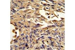 IHC analysis of FFPE human lung carcinoma stained with S100A10 antibody (S100A10 Antikörper  (AA 12-40))