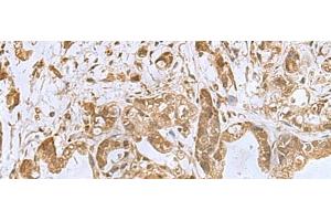 Immunohistochemistry of paraffin-embedded Human gastric cancer tissue using PHF6 Polyclonal Antibody at dilution of 1:85(x200) (PHF6 Antikörper)