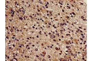 Immunohistochemistry analysis of human glioma using ABIN7148965 at dilution of 1:100 (CBS Antikörper  (AA 1-413))