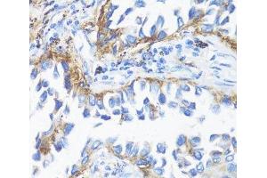 Immunohistochemistry of paraffin-embedded Human lung cancer using HLA-DRB3 Polyclonal Antibody at dilution of 1:100 (40x lens). (HLA-DRB3 Antikörper)