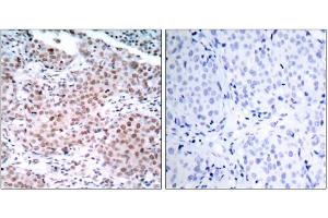 Immunohistochemical analysis of paraffin-embedded human breast carcinoma tissue using Estrogen Receptor-α (phospho-Ser104) antibody (E011070). (Estrogen Receptor alpha Antikörper  (pSer104))