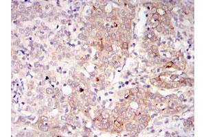 Immunohistochemical analysis of paraffin-embedded human cervical cancer tissues using BLNK monoclonal antibody, clone 5G9  with DAB staining. (B-Cell Linker Antikörper)