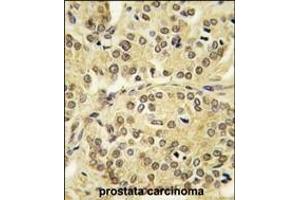 Formalin-fixed and paraffin-embedded human prostata carcinoma tissue reacted with TIEG antibody (N-term) (ABIN392159 and ABIN2841880) , which was peroxidase-conjugated to the secondary antibody, followed by DAB staining. (KLF10/TIEG1 Antikörper  (N-Term))