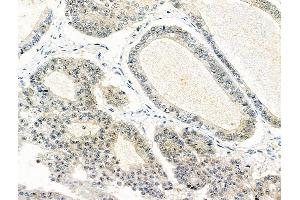 ABIN6259977 and ABIN6276522 at 1/100 staining Human ovarian cancer by IHC-P. (APEX1 Antikörper  (N-Term))