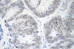 Immunohistochemistry was performed on paraffin-embedded human sigmoid colon carcinoma using EHMT2 antibody (ABIN7797609), 1:200). (Rekombinanter EHMT2 Antikörper)