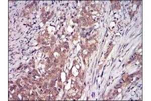 Immunohistochemical analysis of paraffin-embedded human cervical cancer tissues using DDIT3 mouse mAb with DAB staining.