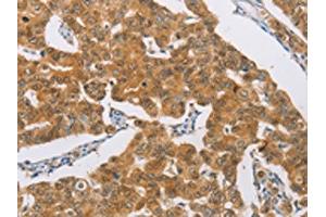 The image on the left is immunohistochemistry of paraffin-embedded Human breast cancer tissue using ABIN7189712(AGAP2 Antibody) at dilution 1/30, on the right is treated with synthetic peptide. (AGAP2 Antikörper)