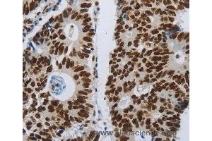 Immunohistochemistry of Human ovarian cancer using SLC16A14 Polyclonal Antibody at dilution of 1:80