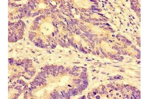 Immunohistochemistry of paraffin-embedded human colon cancer using ABIN7170219 at dilution of 1:100
