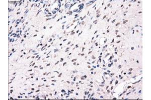 Immunohistochemical staining of paraffin-embedded Adenocarcinoma of breast tissue using anti-MRI1 mouse monoclonal antibody. (MRI1 Antikörper)
