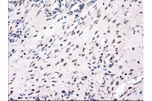 Immunohistochemical staining of paraffin-embedded Adenocarcinoma of breast tissue using anti-MRI1 mouse monoclonal antibody.