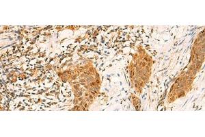 Immunohistochemistry of paraffin-embedded Human esophagus cancer tissue using GINS2 Polyclonal Antibody at dilution of 1:50(x200) (GINS2 Antikörper)