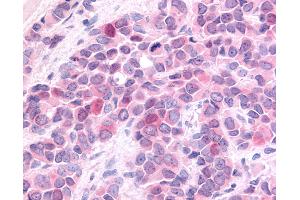 Anti-HUNK / B19 antibody IHC of human Breast, Carcinoma. (HUNK Antikörper  (Internal Region))