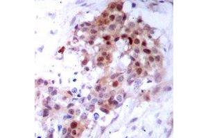 Immunohistochemical analysis of p38 staining in human breast cancer formalin fixed paraffin embedded tissue section. (MAPK14 Antikörper)