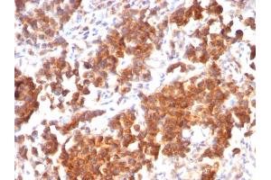 Formalin-fixed, paraffin-embedded human Parathyroid Mass stained with VEGI Mouse Recombinant Monoclonal Antibody (rVEGI /1283). (Rekombinanter TNFSF15 Antikörper)