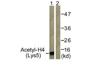 Immunohistochemistry analysis of paraffin-embedded human breast carcinoma tissue, using Histone H4 (Acetyl-Lys5) Antibody. (Histone H4 Antikörper  (acLys5))