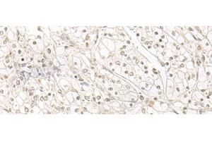 Immunohistochemistry of paraffin-embedded Human kidney cancer tissue using HENMT1 Polyclonal Antibody at dilution of 1:30(x200) (HENMT1 Antikörper)