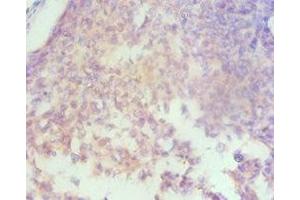 Immunohistochemistry of paraffin-embedded human cervical cancer using ABIN7155960 at dilution of 1:100 (HAS3 Antikörper  (AA 339-553))