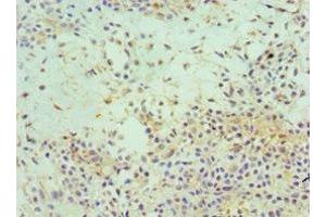 Immunohistochemistry of paraffin-embedded human breast cancer using ABIN7152153 at dilution of 1:100 (EIF3E Antikörper  (AA 1-445))