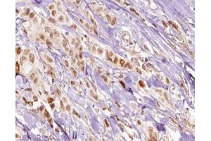 ABIN6266541 at 1/100 staining human breast carcinoma tissue sections by IHC-P.