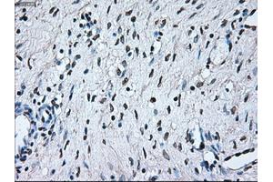 Immunohistochemical staining of paraffin-embedded Adenocarcinoma of colon tissue using anti-BRAFmouse monoclonal antibody. (BRAF Antikörper)