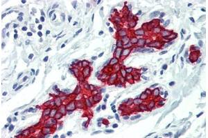 Human Breast (formalin-fixed, paraffin-embedded) stained with KRT19 antibody ABIN396942 at 10 ug/ml followed by biotinylated anti-mouse IgG secondary antibody ABIN481714, alkaline phosphatase-streptavidin and chromogen. (Cytokeratin 19 Antikörper)