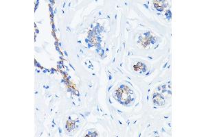 Immunohistochemistry of paraffin-embedded human breast cancer using HRAS antibody (ABIN7267785) at dilution of 1:100 (40x lens). (HRAS Antikörper)
