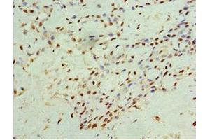 Immunohistochemistry of paraffin-embedded human breast cancer using ABIN7156601 at dilution of 1:100 (IFNGR1 Antikörper  (AA 270-489))