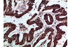 Immunohistochemical analysis of paraffin-embedded human-colon-cancer, antibody was diluted at 1:200 (GREM2 Antikörper  (AA 71-120))