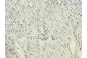Immunohistochemistry of paraffin-embedded human bladder cancer using ABIN7166110 at dilution of 1:100 (SFI1 Antikörper  (AA 1003-1242))